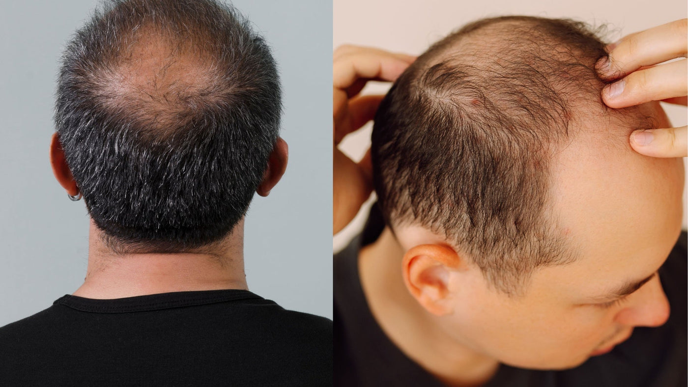 Patrón de calvicie masculina — coronilla y entradas